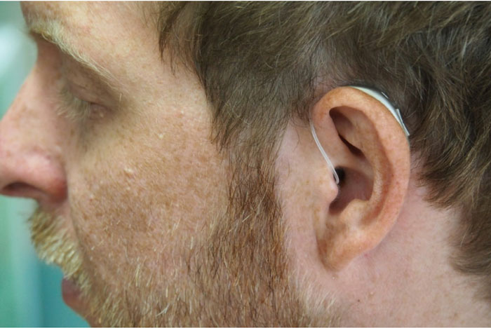 Yngre man som har en bakom-örat hörapparat.